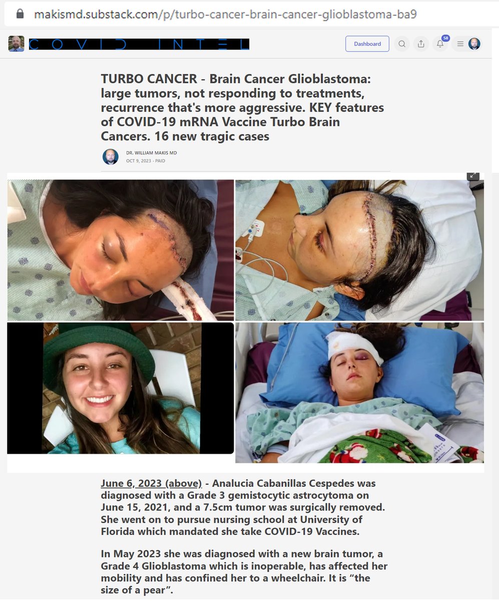 MakisMedicine's tweet photo. NEW ARTICLE: TURBO CANCER - Brain Cancer Glioblastoma: large tumors, not responding to treatments, recurrence that's more aggressive

KEY features of COVID-19 mRNA Vaccine Turbo Brain Cancers 

Large tumors
Rapid re-growth post surgery
poor response to chemo, rad, immuno, anti-angio
recurrence more aggressive & inoperable

COVID-19 mRNA Vaccine INDUCED Turbo Cancers are occurring at highest levels since the mRNA jabs rolled out in Dec.2020.

In my observations, Glioblastomas are in the top 3 most common COVID-19 mRNA Vaccine Turbo Cancers (along with lymphomas and breast cancers).

Patients are describing the following additional features (I provide 16 tragic detailed cases):

Very large tumors (apple sized, pear sized, baseball sized, this is how patients or their families are describing these tumors)

Even when surgery is successful, tumor starts to re-grow much faster than surgeons and oncologists were expecting. 

Poor overall response to chemotherapy, radiation therapy, immunotherapy, anti-angiogenic therapy

When a brain cancer patient was in remission, the brain cancer returns, often more aggressive type and inoperable.

Very poor overall prognosis. Oncologists continue to tell patients they have 12-18 months to live, but patients are dying often within a few months after diagnosis. Oncologists are baffled by the extremely rapid and aggressive course.

COVID-19 mRNA Vaccine Induced Turbo Cancers are a new phenomenon. Oncologists are not recognizing it yet so they are unable to offer their patients any kind of successful treatment at this time.

No research is being done. 99.99% of Oncologists are staying silent to keep their jobs and licenses.

It will be extremely important to listen to patients and their families and what they tell us about these Turbo Cancer brain tumors - Glioblastomas.

Article Link in photo to avoid shadowban, just re-type the URL into your browser

#DiedSuddenly #cdnpoli #ableg
