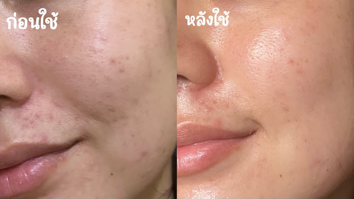 กลับจากทะเลมีผิวแห้ง ระคายเคืองจากการตากแดด เลยได้ เจลครีมศรีจันทร์ตัวช่วยกู้ผิวเร่งด่วนจาก 7-11 มาช่วยให้ความชุ่มชื้น ลดการระคายเคือง โบกก่อนนอน เช้ามาหน้าใส เด้งมาก ซองละ 39บาทเอง ราคาดีสุดๆ #รีวิวเซเว่น