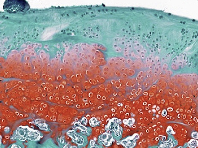 BPoD_s's tweet photo. How #Wntsignalling in cartilage cells underlies #cartilage loss in #osteoarthritis –  StemJEL injectable hydrogel therapy restores the Wnt balance &amp; cartilage &amp; joint function. Image &amp; research by Angela Ruscitto et al @ColumbiaUDental in @CellStemCell. On https://t.co/ZaEDQDOU39 https://t.co/OzCM9aJsXU