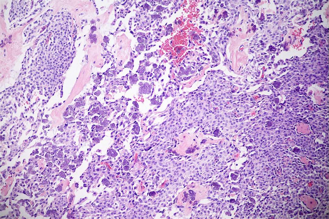 GeronimoJrLapac's tweet photo. Very nice floret-like Tyrosine Crystals in Pleomorphic Adenomas of the Parotid Gland.

#pathology #entpath https://t.co/YmOX8qAx2m