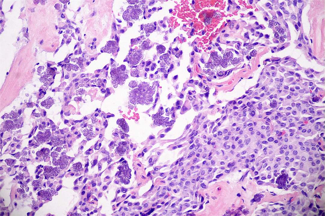 GeronimoJrLapac's tweet photo. Very nice floret-like Tyrosine Crystals in Pleomorphic Adenomas of the Parotid Gland.

#pathology #entpath https://t.co/YmOX8qAx2m