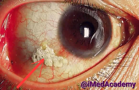 iMedAcademy's tweet photo. 🔆 #Ophthalmology 🔆
🔅 Eye 👁 Disease
○ Bitot’s spot:
Vitamin A deficiency.
#anatomy #Physiology #Ophtha
#iMedAcademy #iMedMedicine
#medicine #surgery #MedTwitter #MedEd #iMed #iMedLab #Med
#NEETUG #MedX #Doctors #NExT
#MedicalStudents #MBBS #BDS
#NEET #FMGE #NEETPG #INICET https://t.co/5GX4PgDDmP