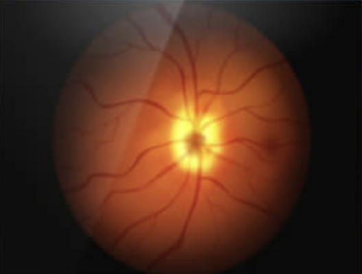 neuralconsult's tweet photo. #optho question of the day!
A 50-year-old man presents to the clinic with sudden vision loss in his right eye. He has a medical history of diabetes and hypertension. On examination, his right eye has reduced visual acuity and an afferent pupillary defect. He also complains of a loss of color vision in the affected eye. Retinal exam is shown below. What is the diagnosis?
Learn more at https://t.co/S6xp9Pocg9
#meded #medx #medtwitter #FOAMed