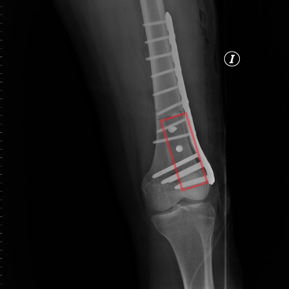 FabLab 3D Hospital Marañón (@3d_maranon) on Twitter photo Surgical guide (CMD IIa) used both to delimit the margin in the allograft and in the patient's own femur, thus ensuring total resection of the tumor and optimal reconstruction <a href="/3d_maranon/">FabLab 3D Hospital Marañón</a> <a href="/rupermac/">Rubén Pérez-Mañanes, MD PhD</a> <a href="/LydiaMediavilla/">LydMed</a> <a href="/calvoharo_ja/">José Antonio Calvo</a> #UPAM3D #HospitalGregorioMarañon #impresion3D Surgical guide (CMD IIa) used both to delimit the margin in the allograft and in the patient's own femur, thus ensuring total resection of the tumor and optimal reconstruction <a href="/3d_maranon/">FabLab 3D Hospital Marañón</a> <a href="/rupermac/">Rubén Pérez-Mañanes, MD PhD</a> <a href="/LydiaMediavilla/">LydMed</a> <a href="/calvoharo_ja/">José Antonio Calvo</a> #UPAM3D #HospitalGregorioMarañon #impresion3D