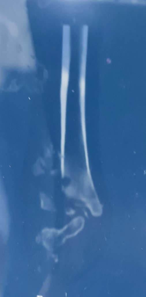 Orthocycle (@orthocycle1) on Twitter photo During this #surgical #charity #mission to #Libya <a href="/Orthocycle1/">Orthocycle</a> used #stimulan for #bone #infection in this #charcot #diabetic #patient - #talus and #distal #tibia dissolved!
#new #techniques - #better #outcomes!
<a href="/BritOrthopaedic/">BOA</a>
<a href="/Orthoconcern/">World Orthopaedic Concern UK</a> <a href="/bota_uk/">BOTA</a> <a href="/Pranai_B/">Pranai Buddhdev</a> <a href="/Biocomposites1/">Biocomposites</a> During this #surgical #charity #mission to #Libya <a href="/Orthocycle1/">Orthocycle</a> used #stimulan for #bone #infection in this #charcot #diabetic #patient - #talus and #distal #tibia dissolved!
#new #techniques - #better #outcomes!
<a href="/BritOrthopaedic/">BOA</a>
<a href="/Orthoconcern/">World Orthopaedic Concern UK</a> <a href="/bota_uk/">BOTA</a> <a href="/Pranai_B/">Pranai Buddhdev</a> <a href="/Biocomposites1/">Biocomposites</a>