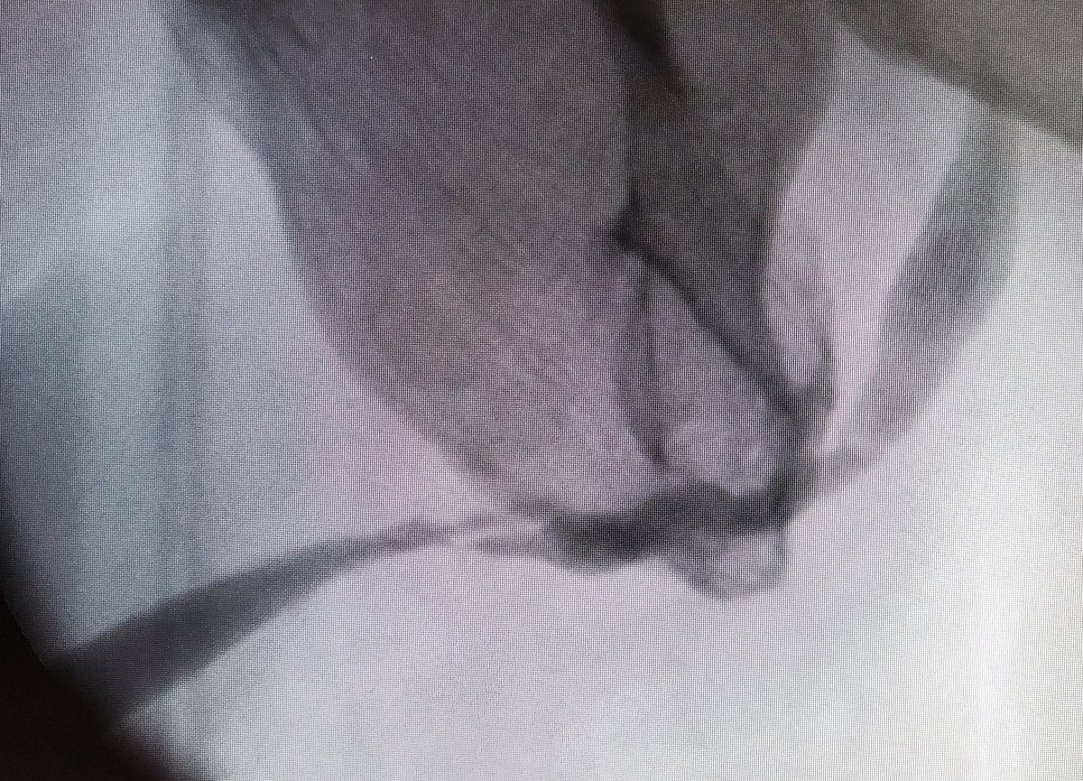 kobirni4enko's tweet photo. BMG augmented anastomotic repair of extended obliterative post-traumatic stricture. Complex case 
#urethroplasty #urethralstricture #Ukraine https://t.co/VvcCxYcug9