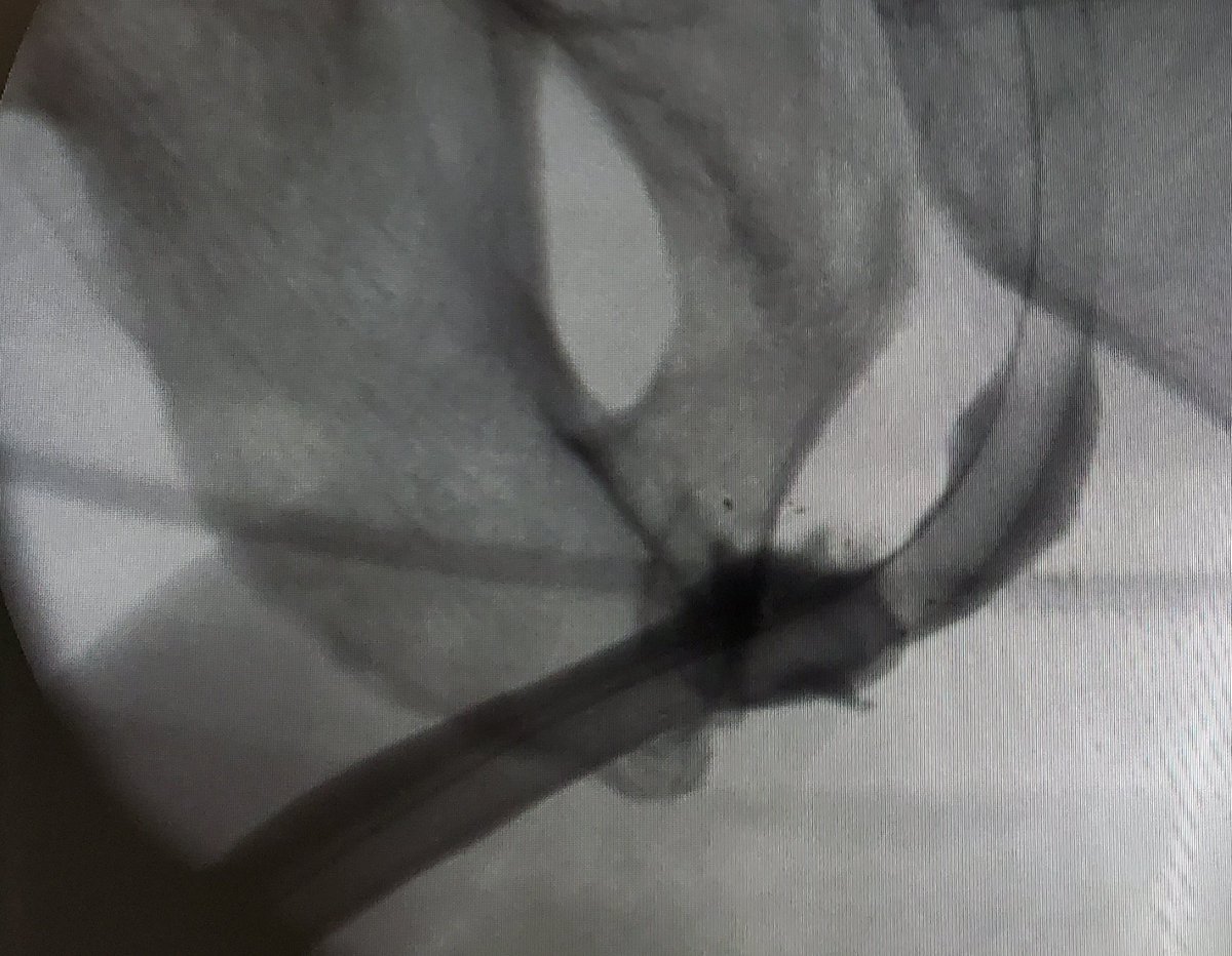 kobirni4enko's tweet photo. BMG augmented anastomotic repair of extended obliterative post-traumatic stricture. Complex case 
#urethroplasty #urethralstricture #Ukraine https://t.co/VvcCxYcug9