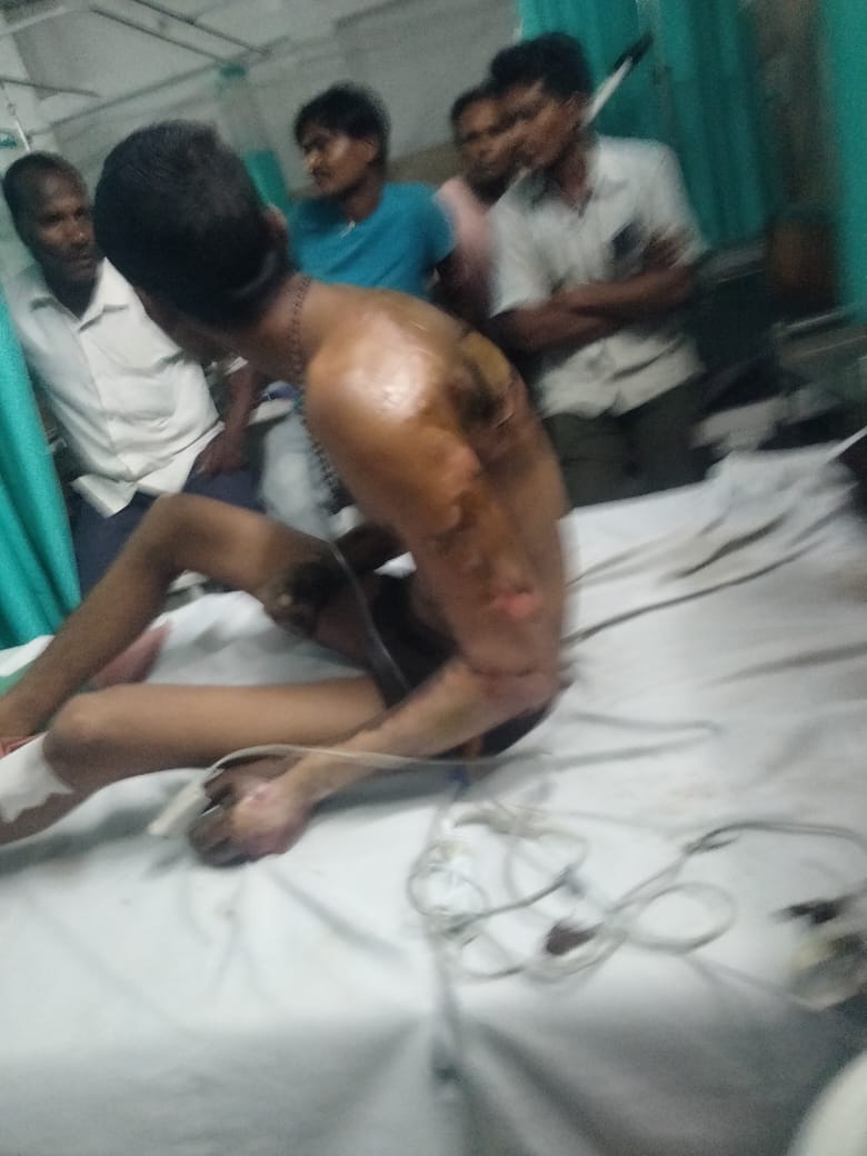 अम्बेडकर नगर जनपद के महरुवा उपकेन्द्र पर कार्य के दौरान बिजली कि चपेट में आने से श्री विपुल बिजली आउटसोर्स कर्मचारी का उपचार के दौरान डाक्टरों द्वारा दाहिना हाथ काट दिया गया।रोज रोज हो रही दुर्घटनाओं को पावर कारपोरेशन द्वारा गंभीरता से नहीं लिया जा रहा है,जो निन्दनीय है।