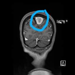 For those who don't know, this is a picture of my wife's brain. This thing has been there for at least 9 years and the ONLY treatment available has been cannabis. It's barely grown in that time, less than 1 mm/year ✌️💚🪴 #CannabisCures #CannabisCommunity #CannaLand
