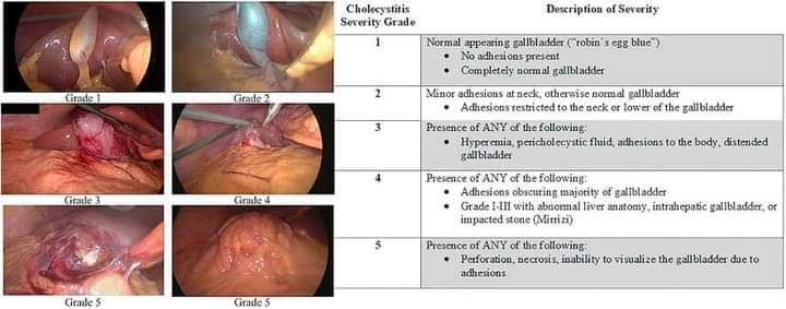 DrJStewart_GS's tweet photo. Parkland Classification - #Cholecystitis:
1️⃣ No stickiness / blue
2️⃣ Adhesions to the neck + normal #gallbladder
3️⃣ Hyperemia, distention, inflammatory fluid, adhesions to the body
4️⃣ Adhesions that cover almost everything / #Mirizzi
5️⃣ Necrosis, perforation, cover x adhesions https://t.co/rW2AtdXguK