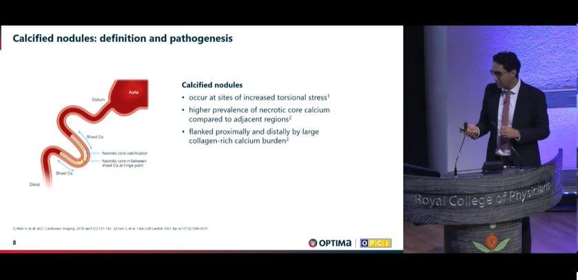 Zill_cardio's tweet photo. Dr. Ziad Ali demystifying the concept of Calcified nodules
#OptimalPCI 2023 @OptimaCTO @WondrEvents #CardioTwitter https://t.co/tVC4WKBo6m