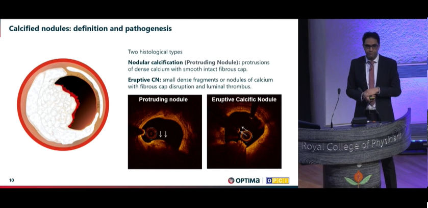 Zill_cardio's tweet photo. Dr. Ziad Ali demystifying the concept of Calcified nodules
#OptimalPCI 2023 @OptimaCTO @WondrEvents #CardioTwitter https://t.co/tVC4WKBo6m
