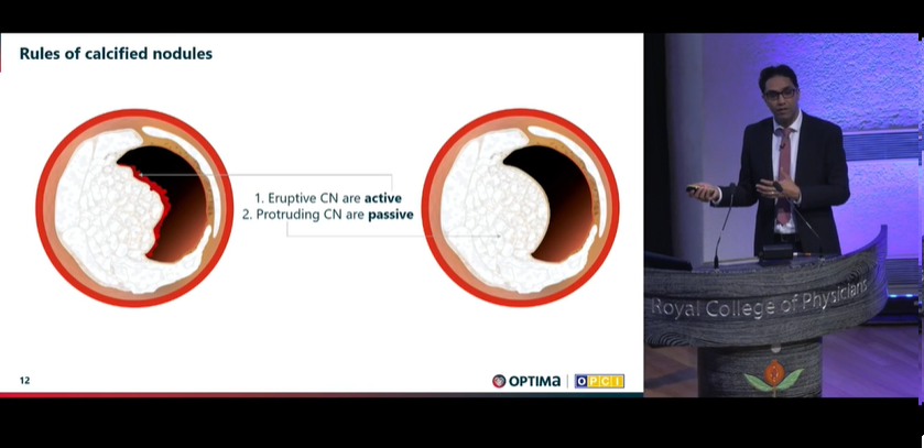 Zill_cardio's tweet photo. Dr. Ziad Ali demystifying the concept of Calcified nodules
#OptimalPCI 2023 @OptimaCTO @WondrEvents #CardioTwitter https://t.co/tVC4WKBo6m