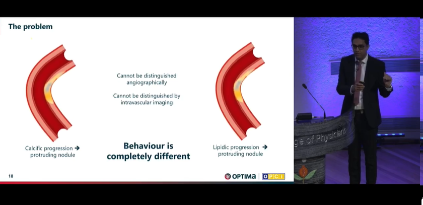 Zill_cardio's tweet photo. Dr. Ziad Ali demystifying the concept of Calcified nodules
#OptimalPCI 2023 @OptimaCTO @WondrEvents #CardioTwitter https://t.co/tVC4WKBo6m