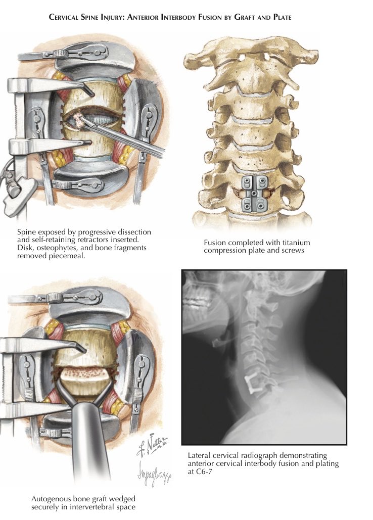 Pcf Surgery Posterior Cervical Fusion Anatomy