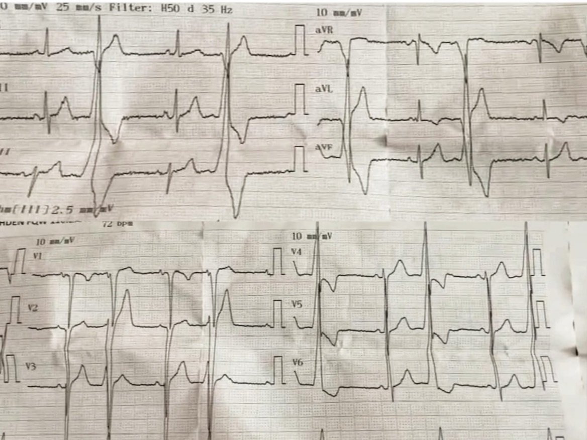 Yuksek Ihtisas Arrhythmia- Ankara City Hospital tweet media