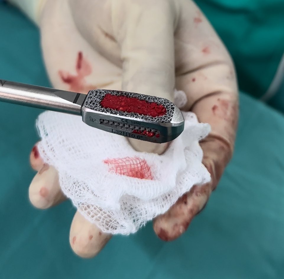 pterion77's tweet photo. Pte52 a.con dolor lumbar crónico severo por discopatia degenerativa L4-L5, fue llevado a  TLIF  mis más tornillos percutaneos, alta al siguiente día con mejoría de los sintomas, @pablopenatapia @HospitaldelRio #columnavertebral #colunavertebral #spinesurgery #TLIF #miss https://t.co/Lr6IatB1Tf