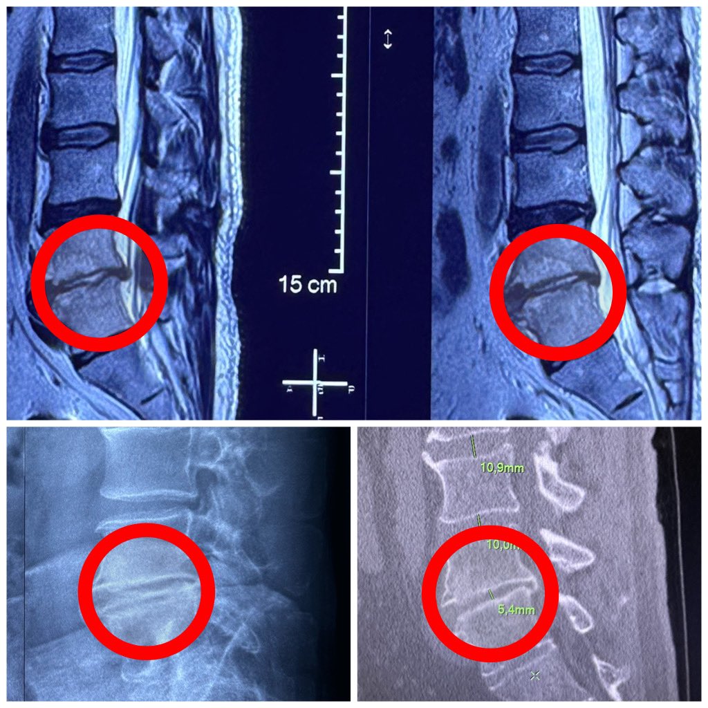 pterion77's tweet photo. Pte52 a.con dolor lumbar crónico severo por discopatia degenerativa L4-L5, fue llevado a  TLIF  mis más tornillos percutaneos, alta al siguiente día con mejoría de los sintomas, @pablopenatapia @HospitaldelRio #columnavertebral #colunavertebral #spinesurgery #TLIF #miss https://t.co/Lr6IatB1Tf