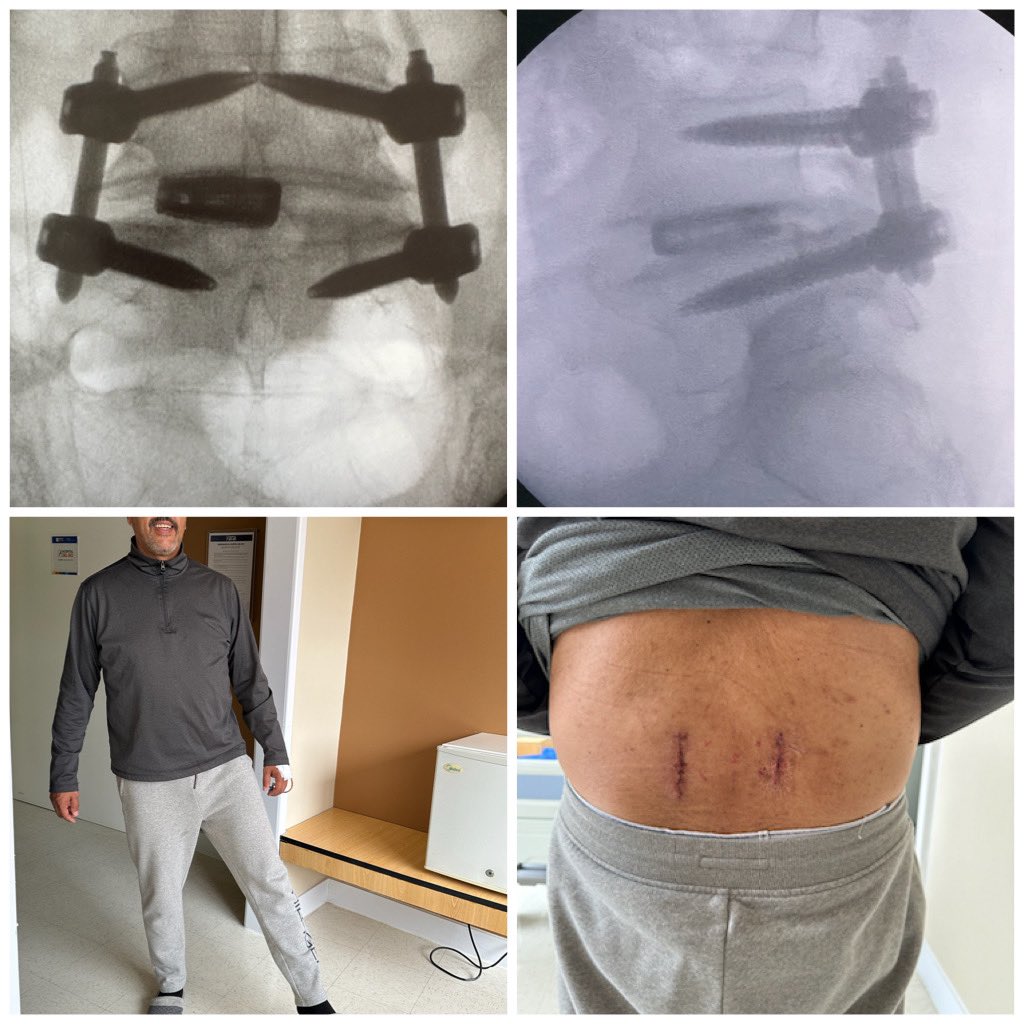 pterion77's tweet photo. Pte52 a.con dolor lumbar crónico severo por discopatia degenerativa L4-L5, fue llevado a  TLIF  mis más tornillos percutaneos, alta al siguiente día con mejoría de los sintomas, @pablopenatapia @HospitaldelRio #columnavertebral #colunavertebral #spinesurgery #TLIF #miss https://t.co/Lr6IatB1Tf
