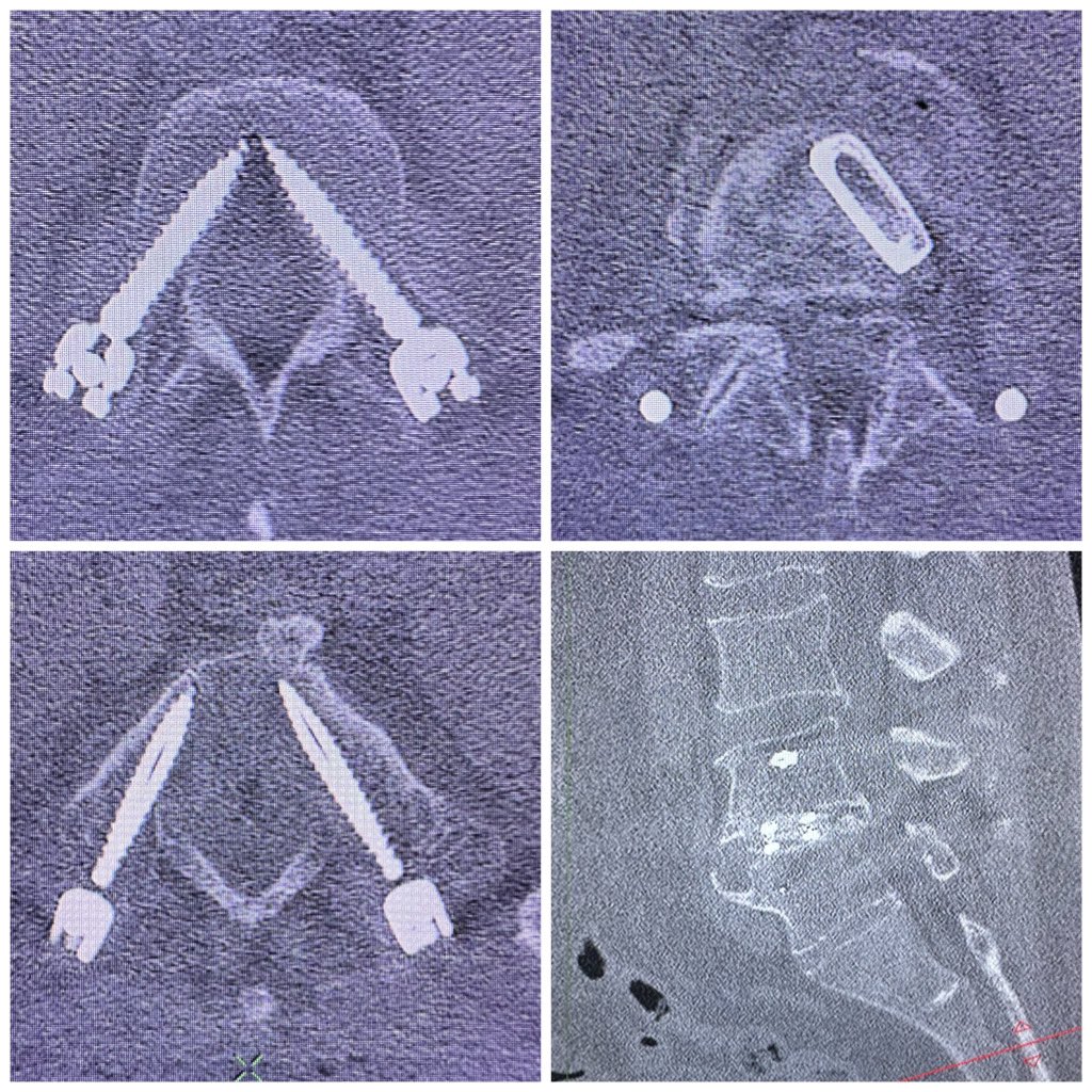 pterion77's tweet photo. Pte52 a.con dolor lumbar crónico severo por discopatia degenerativa L4-L5, fue llevado a  TLIF  mis más tornillos percutaneos, alta al siguiente día con mejoría de los sintomas, @pablopenatapia @HospitaldelRio #columnavertebral #colunavertebral #spinesurgery #TLIF #miss https://t.co/Lr6IatB1Tf