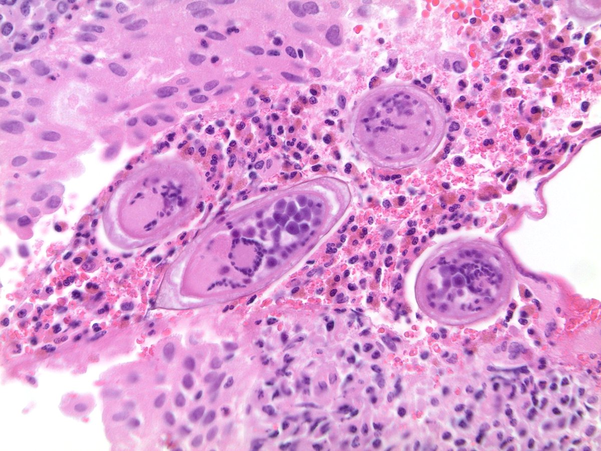 Bladder - Schistosomiasis #PathTwitter #GUPath #PathBugs #PathOutPic