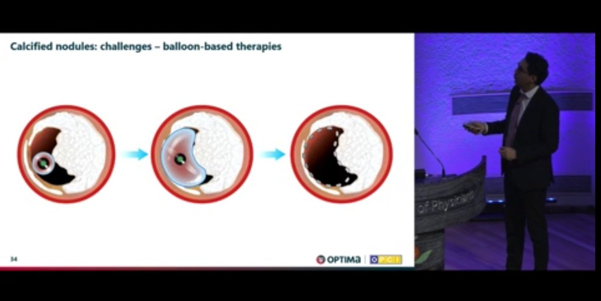 Zill_cardio's tweet photo. Here are some excellent slides illustrating the relative impact of different therapeutic options on calcified nodules from the phenomenal talk 👇
#OptimalPCI 2023 @OptimaCTO @WondrMedical #1/2 https://t.co/nlNrnjy4u9