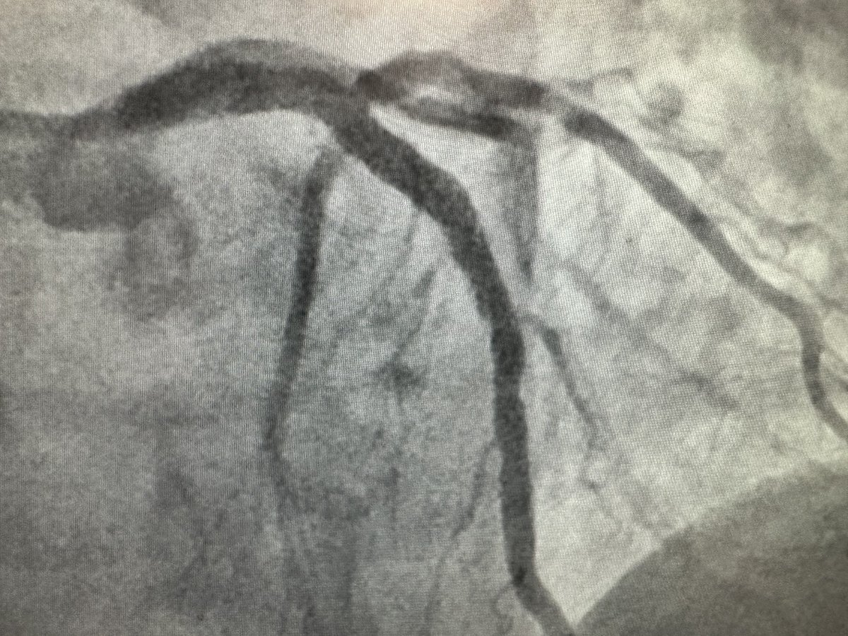 mandeep_mayo's tweet photo. Some strategies to adopt for a undilatable lesion. It is not uncommon to combine 2 lesion modification techniques (Rotatripsy). Use IV imaging to decide your strategy. My preference is Rota (for non bifurcation) and IVL for bifurcation lesion. You can use scoring/cuttingOPN 🎈 https://t.co/dTu2toKUTh