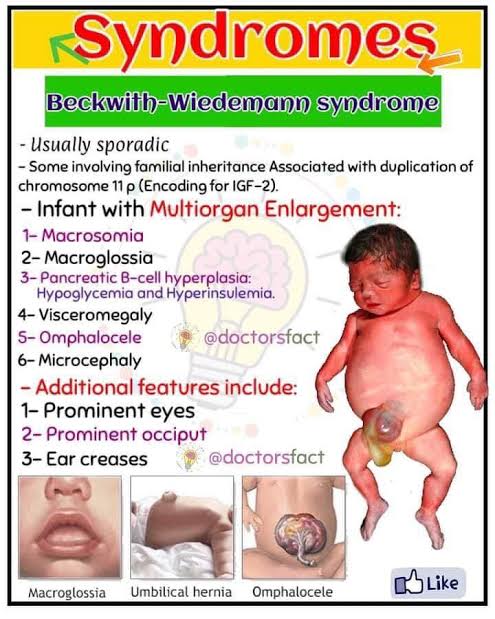 What Is Beckwith Wiedemann Syndrome