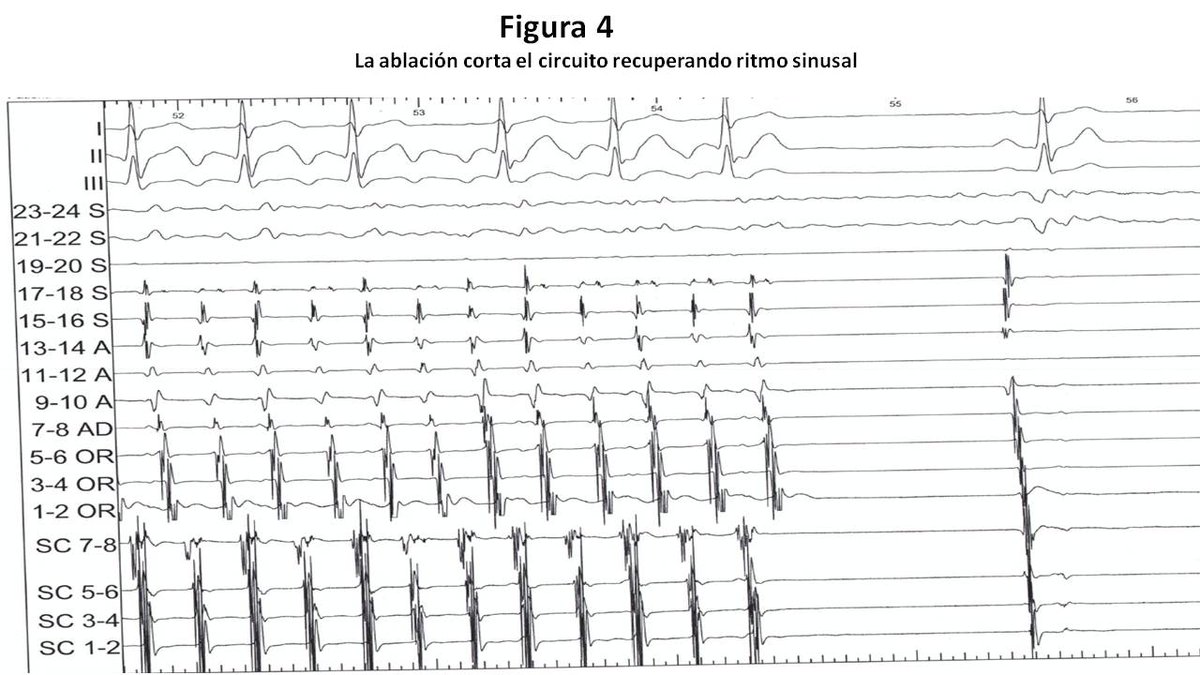 Ablación del Istmo Cavo tricuspídeo paciente con Flutter Auricular 

ℹ️ Qué es el Flutter auricular, síntomas y tratamiento

#arritmias #flutterauricular #ablación #cardiología #EEF #electrocardiograma @jose_lezo 

🔗grupocorpal.com/ablacion-del-i…