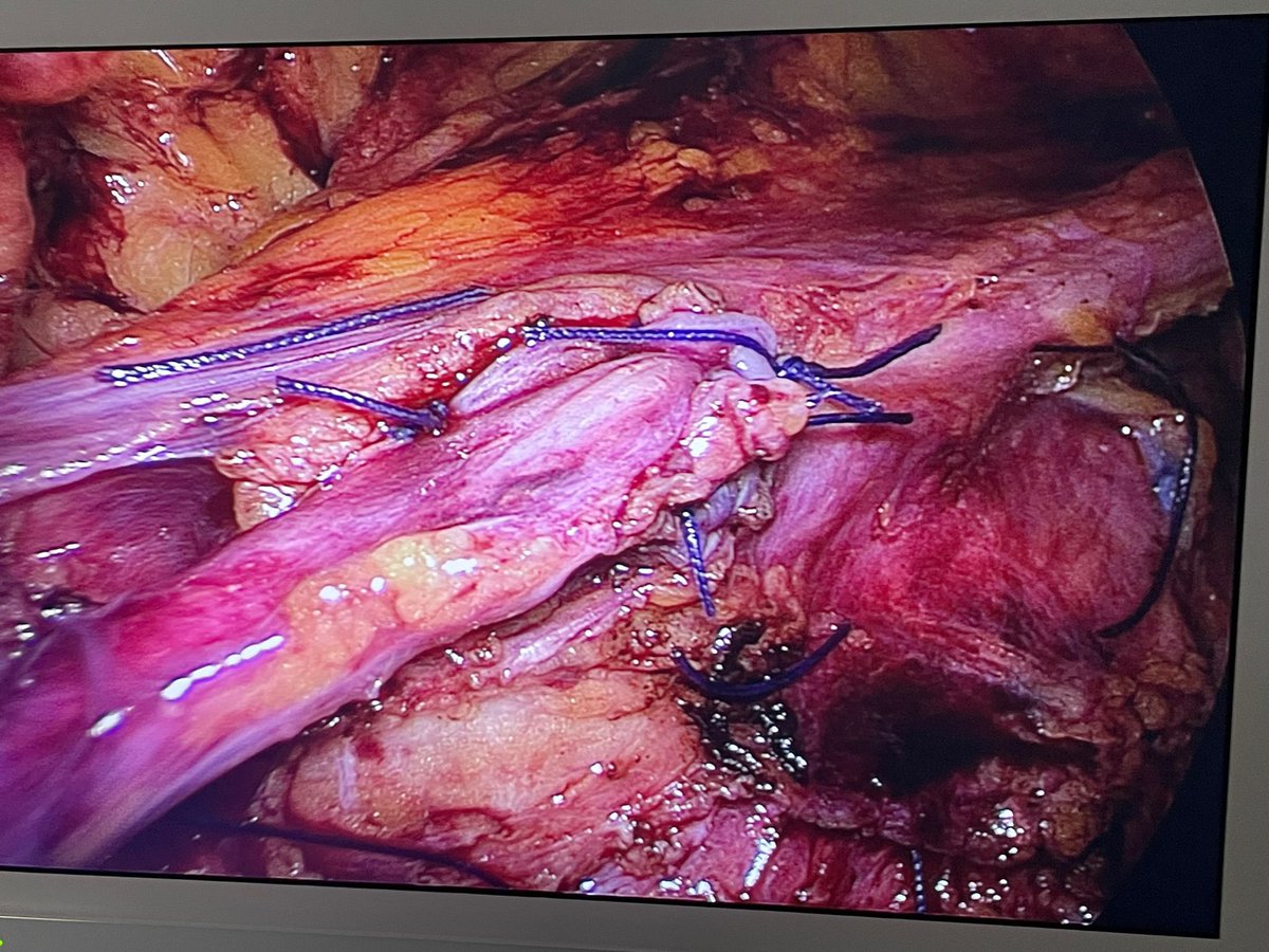Dibi_Fra's tweet photo. Last week at #NuovaVillaClaudia we performed ✌️ reconstructive surgeries:
1) #LPS #segmentaryureterectomy with end-to-end anastomosis for a lumbar ureteral stenosis

2) LPS #ureteralreimplantation with BPH in a young woman with a iatrogenic stenosis of the pelvic ureter

🔝Team! https://t.co/Cd8wiM82eG