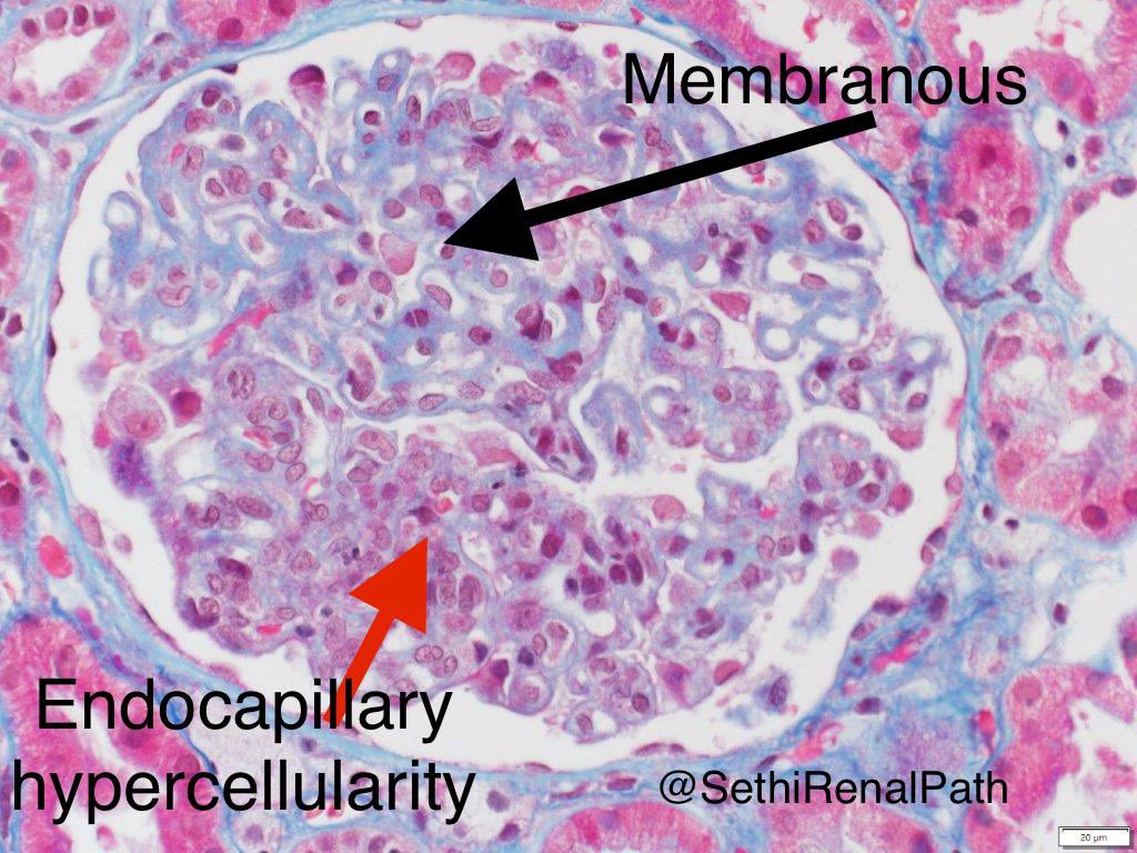 Two different lesions in one glomerulus. 

Top half: thickened GBM, no inflammation

Bottom half: endocapillary hypercellularity, segmental

Dx: 1) Focal lupus nephritis, class III; 2) Membranous lupus nephritis, class V

29 yr lupus pt with 8 gms proteinuria, Cr 0.9, albumin 1.8