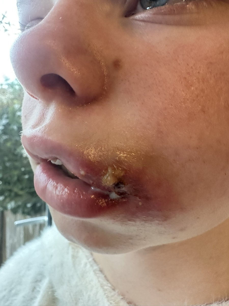 YorksParamedic's tweet photo. Ended up need excision and drainage https://t.co/w22SmhDVpH