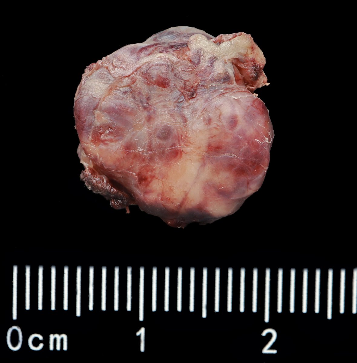 Andrew_Fltv's tweet photo. F,53y/o, parathyroid adenoma, parathyroidectomy (left inferior).
1/
Parathyroid adenoma may show fibrosis, areas of hemorrhage, hemosiderin deposition, cholesterol clefts,  focal endocrine atypia🧵 https://t.co/ynq7kiXx1a