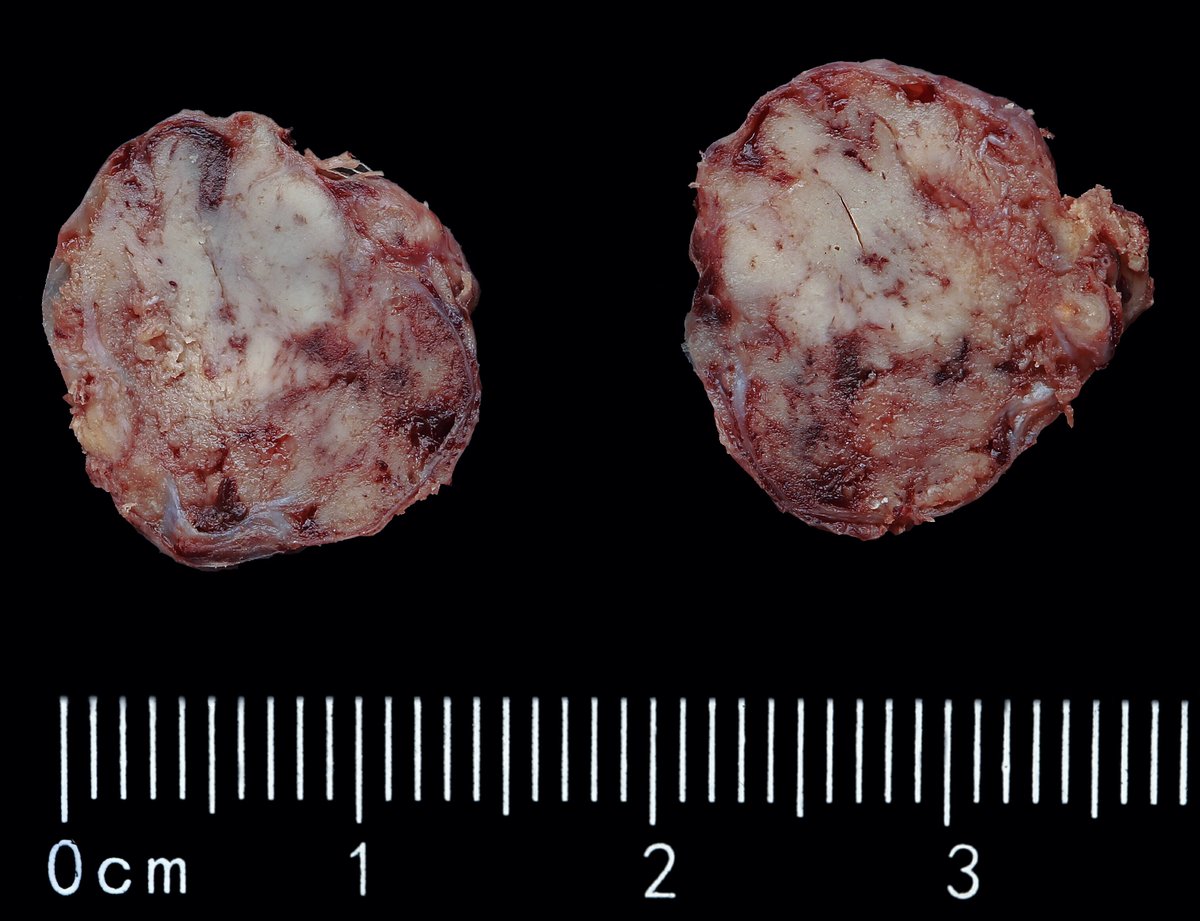 Andrew_Fltv's tweet photo. F,53y/o, parathyroid adenoma, parathyroidectomy (left inferior).
1/
Parathyroid adenoma may show fibrosis, areas of hemorrhage, hemosiderin deposition, cholesterol clefts,  focal endocrine atypia🧵 https://t.co/ynq7kiXx1a