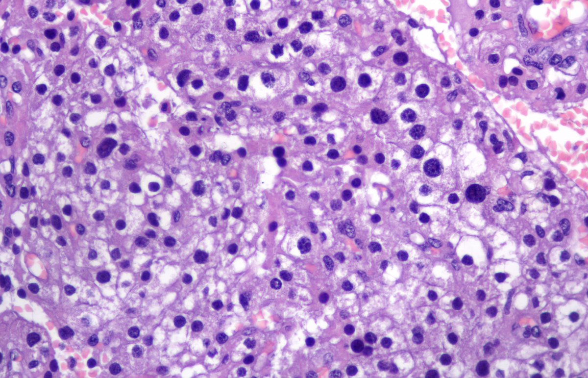 Andrew_Fltv's tweet photo. F,53y/o, parathyroid adenoma, parathyroidectomy (left inferior).
1/
Parathyroid adenoma may show fibrosis, areas of hemorrhage, hemosiderin deposition, cholesterol clefts,  focal endocrine atypia🧵 https://t.co/ynq7kiXx1a