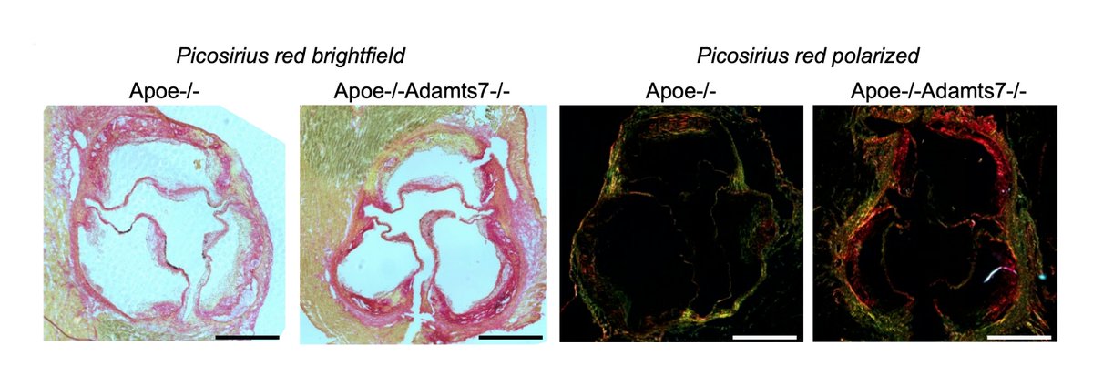 Circulation Research (@circres) on Twitter photo Sharifi et al describe a new mechanism for #CAD gene ADAMTS7 in degrading #TIMP1. Learn how this modulates plaque collagen content & could influence plaque stability in #atherosclerosis ahajrnls.org/3RHSgEc
@thokessl @LarsMaeg <a href="/JeanetteErdmann/">Jeanette Erdmann</a> <a href="/tnndng/">Tan An Dang</a> Sharifi et al describe a new mechanism for #CAD gene ADAMTS7 in degrading #TIMP1. Learn how this modulates plaque collagen content & could influence plaque stability in #atherosclerosis ahajrnls.org/3RHSgEc
@thokessl @LarsMaeg <a href="/JeanetteErdmann/">Jeanette Erdmann</a> <a href="/tnndng/">Tan An Dang</a>