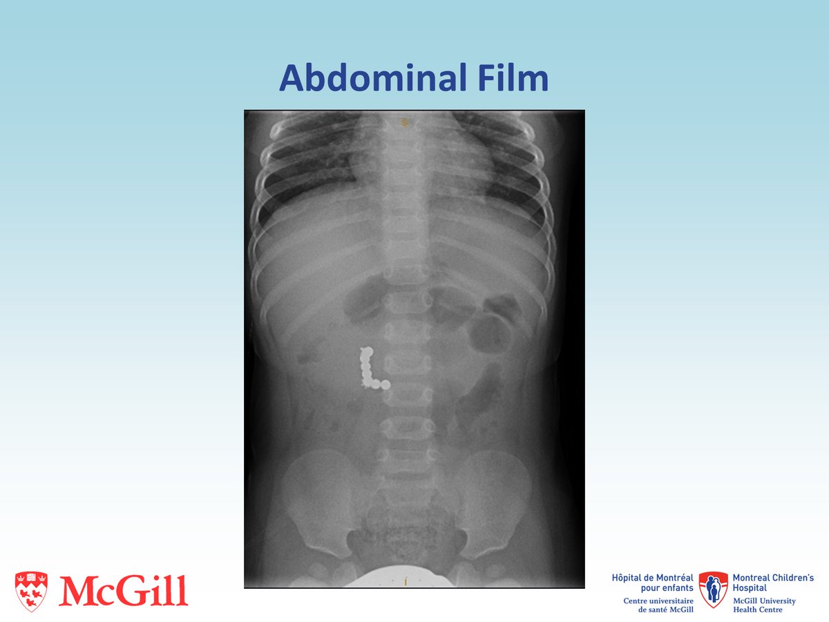 CBCLIPS # 43
A 15-month old boy is in the ER after one episode of non-bilious emesis. His parents found a number of small magnets, from his sister’s toy, in his bed. His vitals and abdominal exam are normal. An abdominal film is shown. What would you do next?
#MedTwitter