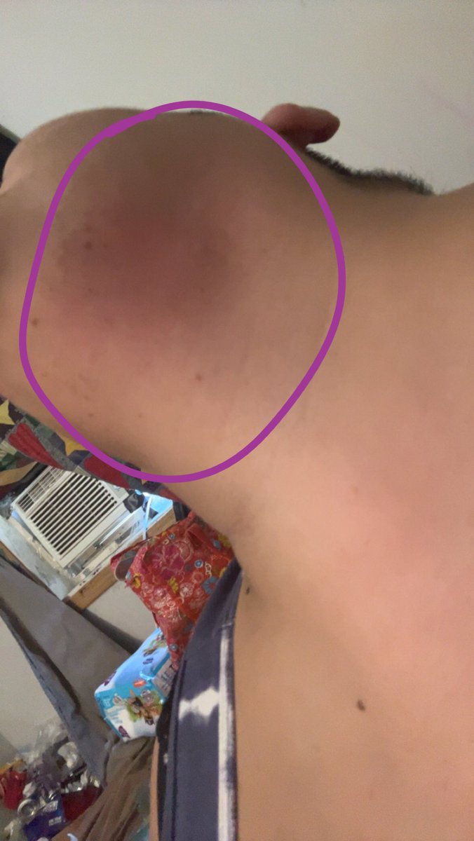 I forgot how much bee stings hurt 😢