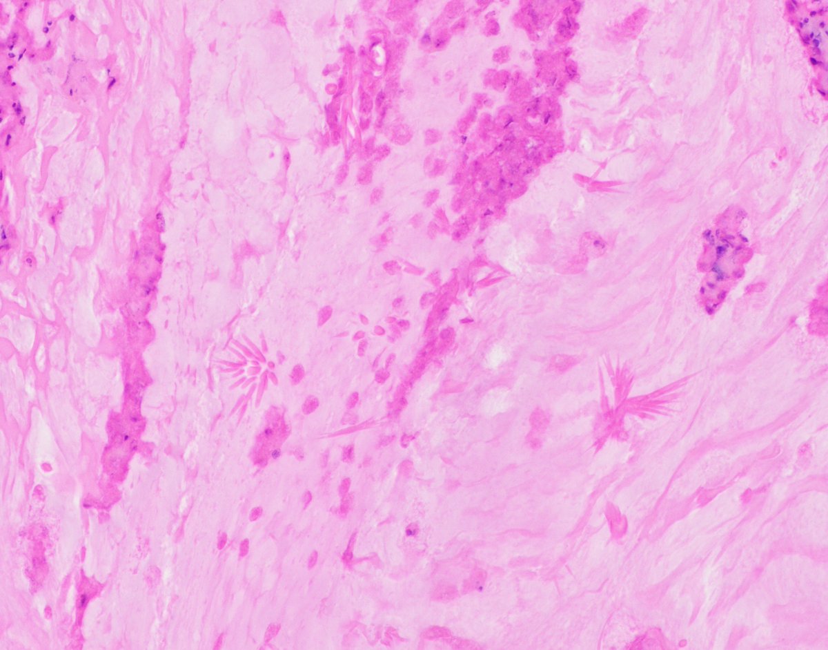 Charcot-Leyden crystals in 'allergic mucin' from a case of allergic sinusitis. #ENTpath #PathTwitter