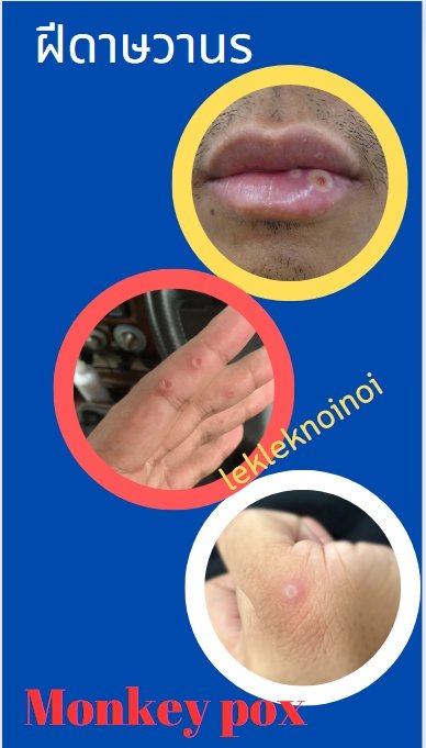 lekanoi's tweet photo. ฝีดาษลิง : จำนวนผู้ติดเชื้อเพิ่มขึ้นเรื่อยๆ

วัคซีนก็รอไปก่อน ไม่รู้ว่าทางรัฐบาลจะมีมาตร��ารการป้องกันยังไง https://t.co/MjJTvZT4aR