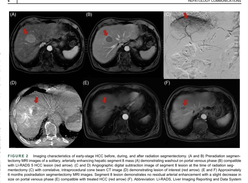 Y-90 for liver cancer This review is amazing and taught me so much journals.lww.com/hepcomm/fullte… #livertwitter @AnjanaPillaiMD
