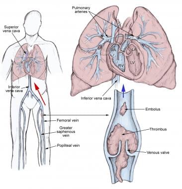 #Pulmonarydisease cause death::
Chronic obstructive #pulmonarydisease (COPD) is a progressive condition, which means it gets steadily worse. Over time, the body becomes less able to take in enough oxygen. End stage #COPD is the most severe stage.