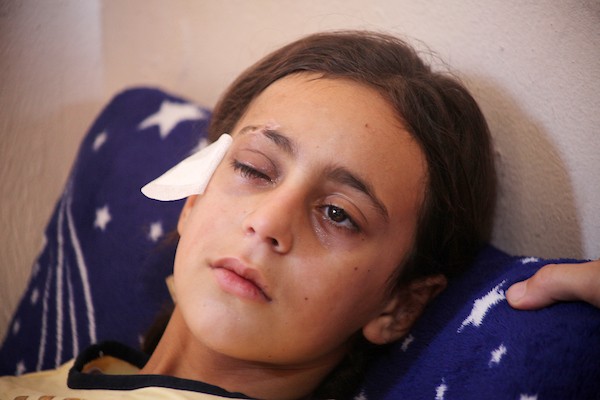 Yusef8A's tweet photo. Remember Areej? The little girl who lost her eye by shrapnel from an occupation missile, The doctors’ final decision was to remove the eye and implant a cosmetic eye, It's an urgent appeal 🙏🇵🇸⤵️
https://t.co/NRGE6Wj3Wt https://t.co/M2UsogDfgt