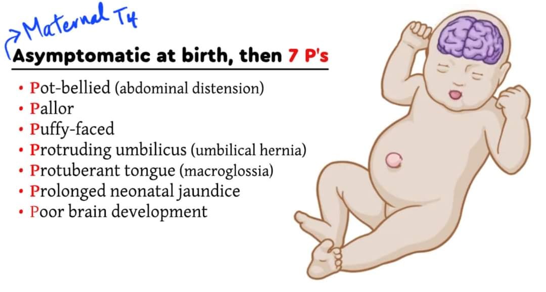 Medicine_keys's tweet photo. Features of congenital hypothyroidism. 

You can try our flashcards from here,
https://t.co/DsZU6VLlvA 

#MRCP
#MRCP_UK
#PACES
#Internal_Medicine 
#Endocrinology 
#Medicine_Keys_Flashcards https://t.co/HdP2Kexblj