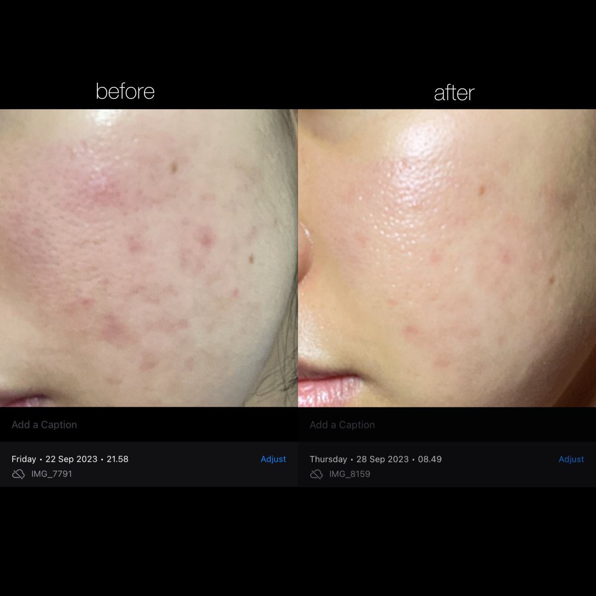 myssweatheart's tweet photo. bulan ini breakout parah karna emang mau haid + polusi lagi jelek bgttt😭

lagi rutin pake serum acne ini ternyata setelah 7 hari lumayan ampuh banget buat jerawat meradang, jerawat kecil dan bekas jerawatnya!!
#racuninskincare https://t.co/42NDntG7wx