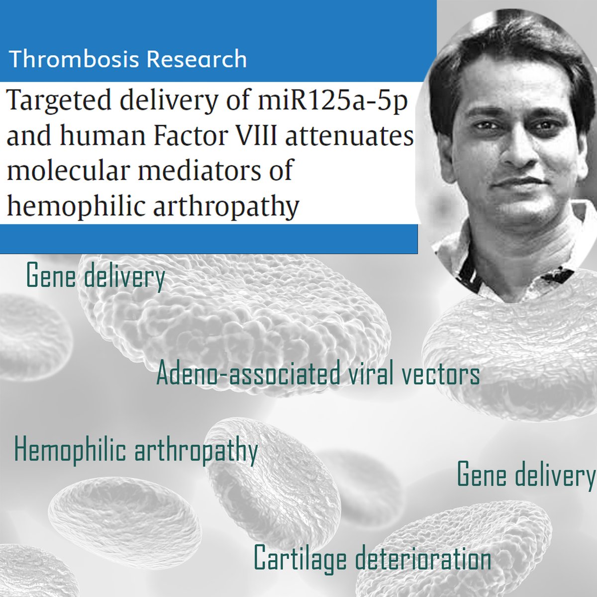 mfcem_iitk's tweet photo. Hemophilia causes bleeding into joint cavities resulting in Hemophilic arthropathy (HA). Prof. Jayandharan Rao &amp; team show administration of miR125a-5p decreases HA-linked inflammation &amp; cartilage-degradation.
https://t.co/lmC0Kh9nAd
@BSBEIITK1 @MehtaFF
#GeneTherapy https://t.co/WFCqDCuP03