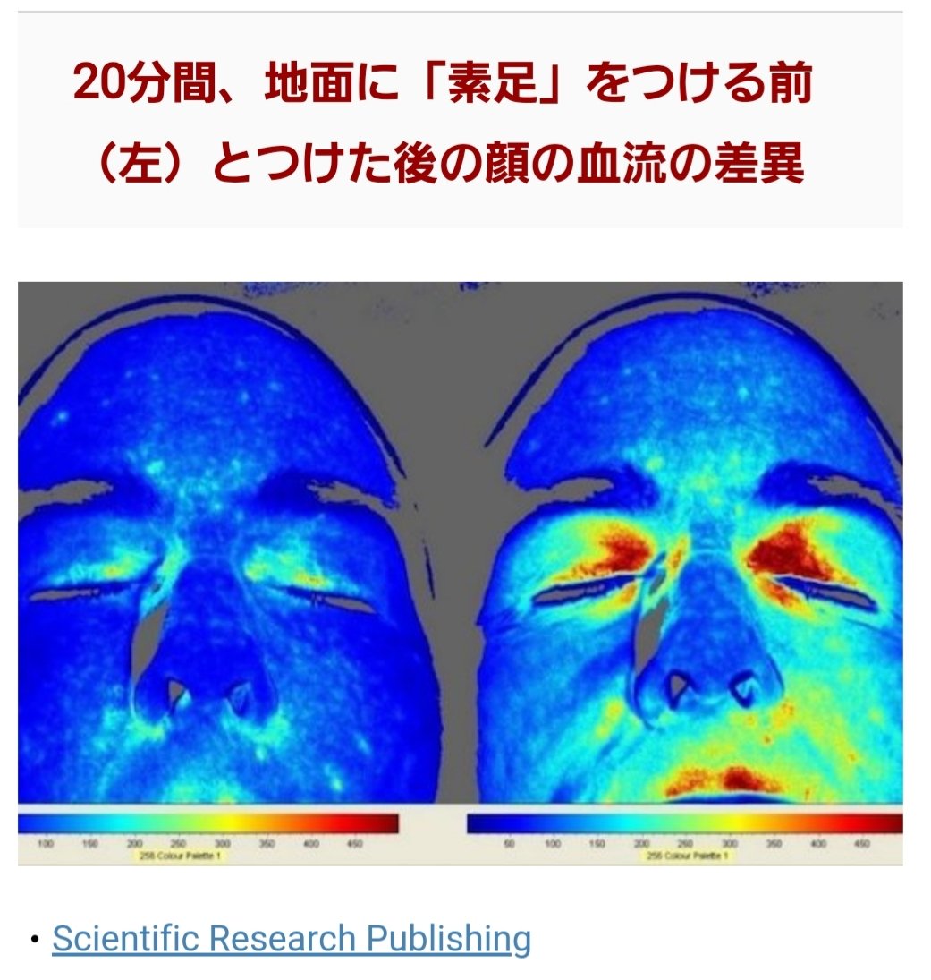 kintsuzuike's tweet photo. 裸足の価値に戻ると、やっぱり"アーシング"に触れないわけにいかない。

スピっぽいと評判のアーシングだが真面目に研究されてたりする🤭

左画像：「素足で地面に20分間立っているだけで大きな血流の差が出る」カリフォルニア大学アーバイン校細胞生物学部門による研究。裸足で地面に直に触れると顔の血流が促進される。

右画像：ジュジュべ・ハワイ・クリニック院長東洋医学博士亀井士門医師の監修。人は静電気が帯電すると血球同士がくっつき血流が滞る。アーシングによる放電で体内の電気がバランスする。

人のエネルギー代謝の産物は電子。人は電子で動く生命体。大地の電子と交流することで恒常性が保たれている。

昔は裸足の人が多く日本でも雪駄や草鞋、下駄など導電性素材でできた履物で不整地を歩いていたが、現代は絶縁性のゴム底のシューズを履き、絶縁性の高いコンクリートやアスファルトの上を歩く。大地と接せる機会がかなり少なくなっている。

自然の中にいると、たとえば、山や川での活動でエネルギーが満ちる感覚になるのはまさにアーシングの恩恵なのだ。
#アーシング
#裸足