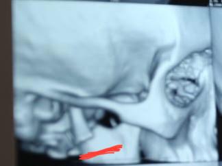 DrManikSaha2's tweet image. As an Oral &amp;amp; Maxillo-Facial Surgeon, I have managed the time to return to my old working place at Tripura Medical College &amp;amp; Dr. BRAM Teaching Hospital, Hapania to treat a patient with Rt. Sub-Condylar fracture(#). 
The patient is an MBBS doctor and was my student and he met an…