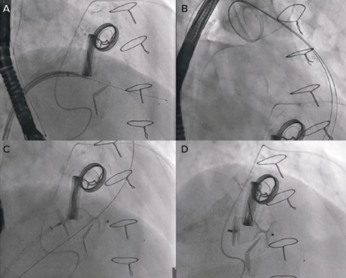 Jonyap88's tweet photo. Practical tips and tricks on tricuspid paravalvular leak closure. https://t.co/4AfwWM7azI @jacktanwc #Nhcs #StucturalIntervention #CardioTwitter #JAPSC https://t.co/gBzNATYO8e