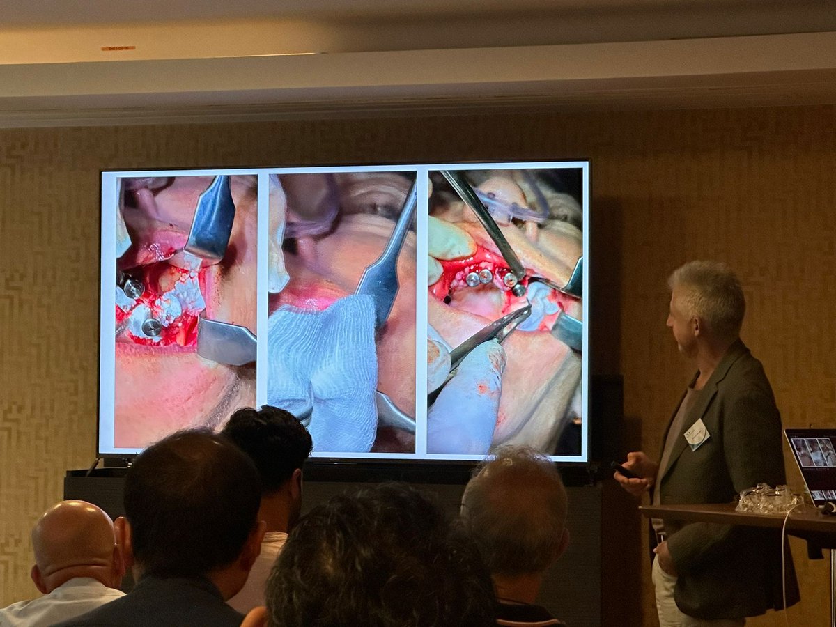 EthossCo's tweet image. Take a look at some pictures from our recent event in Dusseldorf...

Dr. Costa Nicolopoulos led an insightful lecture, delving into the integration of EthOss with Zygomatic Implants.

#zygomaticimplants #ethossbonegraft #dentalimplants #dentalbonegraft #implantlecture